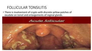 FOLLICULAR TONSILITIS
• There is involvement of crypts with discrete yellow patches of
exudate on tonsil and enlargements of reginal glands.
 