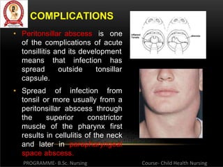 tonsillitis-pptx