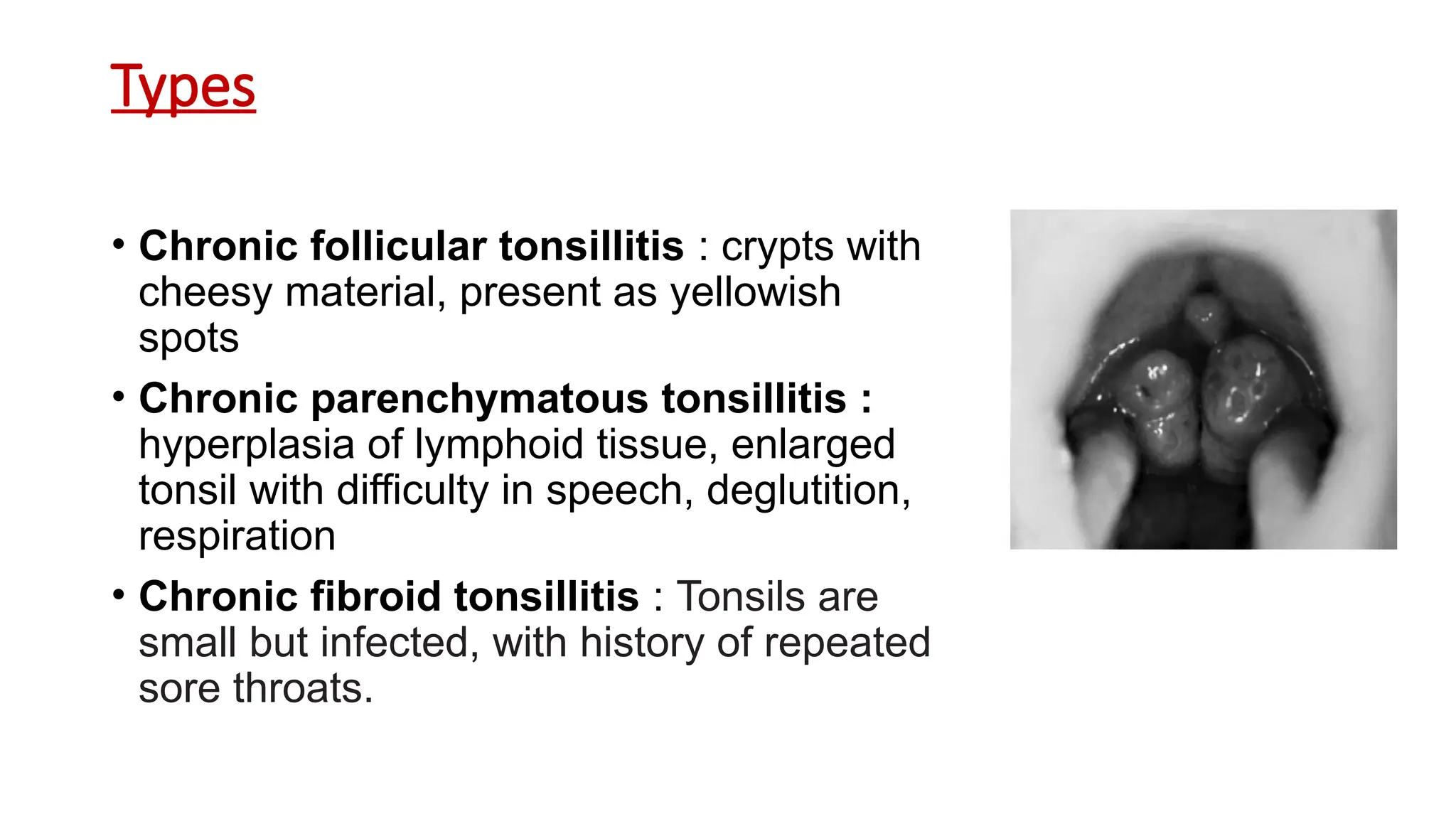Types
• Chronic follicular tonsillitis : crypts with
cheesy material, present as yellowish
spots
• Chronic parenchymatous tonsillitis :
hyperplasia of lymphoid tissue, enlarged
tonsil with difficulty in speech, deglutition,
respiration
• Chronic fibroid tonsillitis : Tonsils are
small but infected, with history of repeated
sore throats.
 