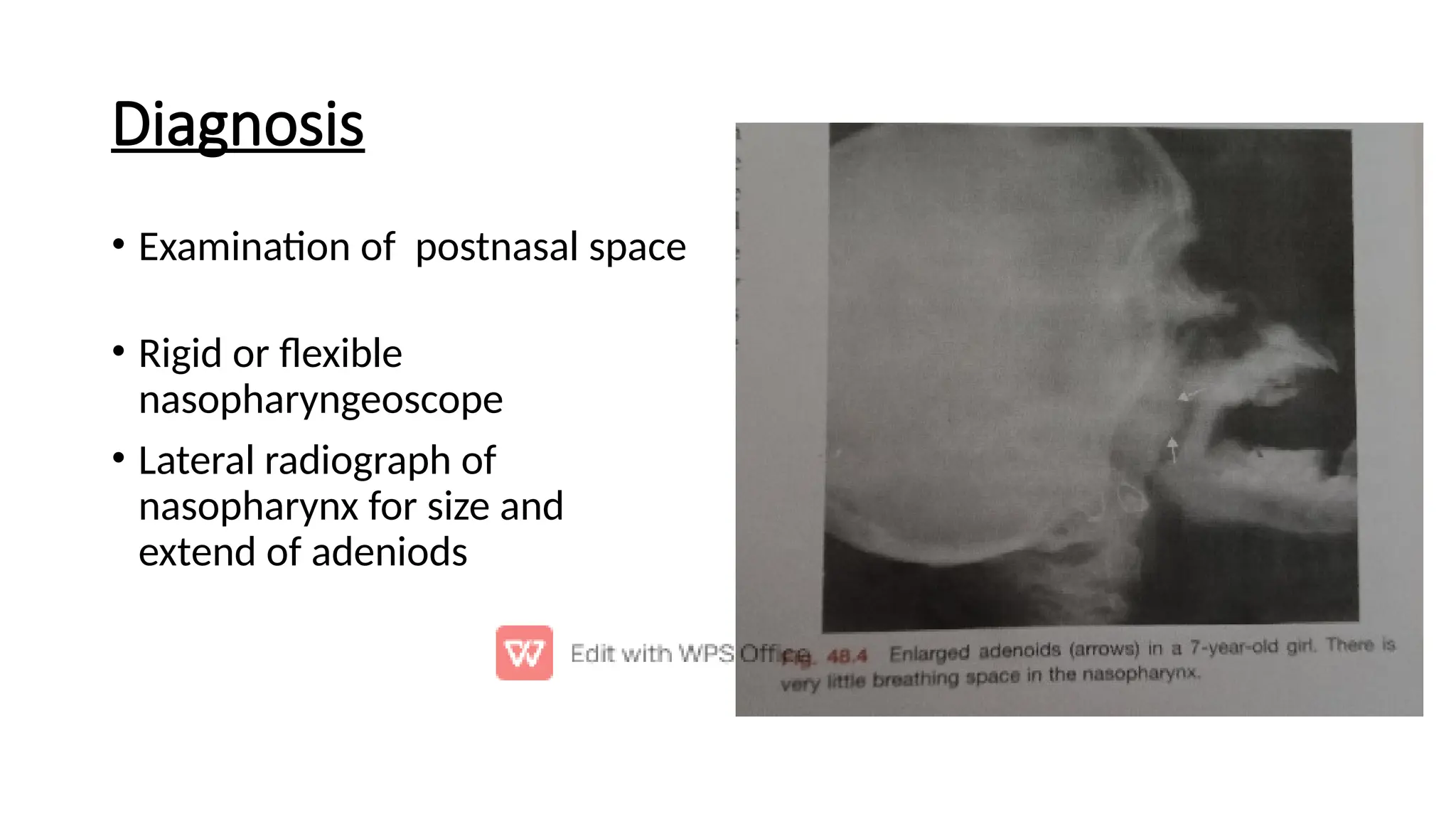 Diagnosis
• Examination of postnasal space
• Rigid or ﬂexible
nasopharyngeoscope
• Lateral radiograph of
nasopharynx for size and
extend of adeniods
 
