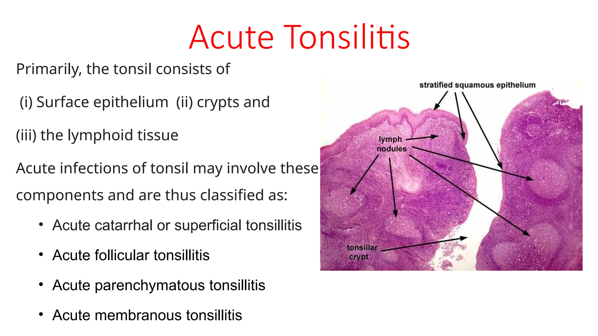 Acute Tonsilitis
Primarily, the tonsil consists of
(i) Surface epithelium (ii) crypts and
(iii) the lymphoid tissue
Acute infections of tonsil may involve these
components and are thus classified as:
• Acute catarrhal or superficial tonsillitis
• Acute follicular tonsillitis
• Acute parenchymatous tonsillitis
• Acute membranous tonsillitis
 