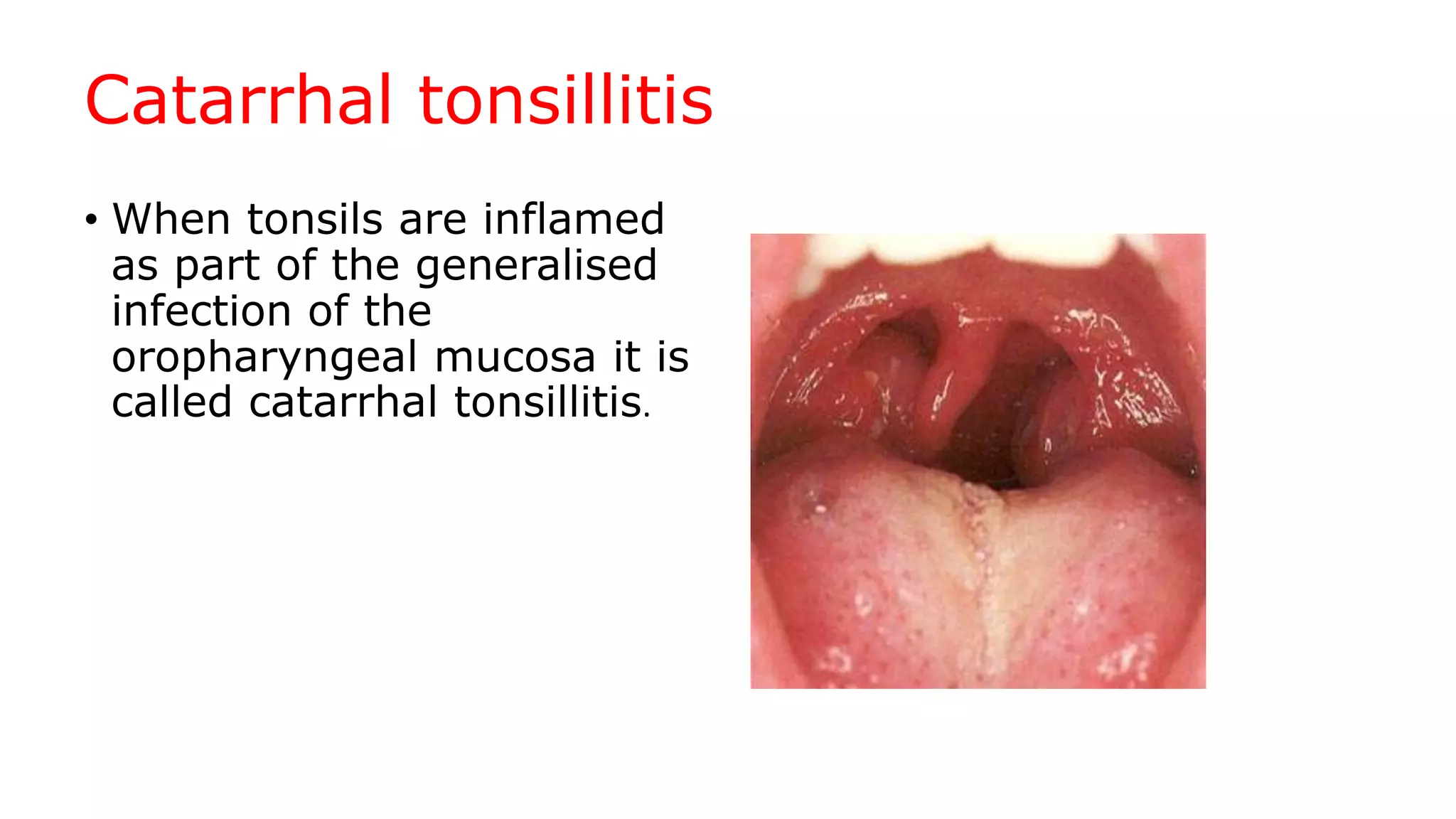Catarrhal tonsillitis
• When tonsils are inflamed
as part of the generalised
infection of the
oropharyngeal mucosa it is
called catarrhal tonsillitis.

 