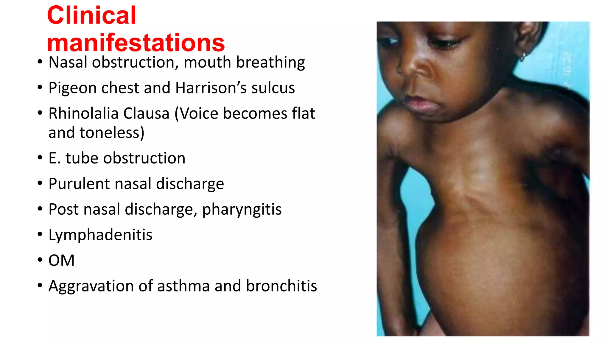 Clinical
manifestations

• Nasal obstruction, mouth breathing
• Pigeon chest and Harrison’s sulcus
• Rhinolalia Clausa (Voice becomes flat
and toneless)
• E. tube obstruction
• Purulent nasal discharge
• Post nasal discharge, pharyngitis
• Lymphadenitis
• OM
• Aggravation of asthma and bronchitis

 