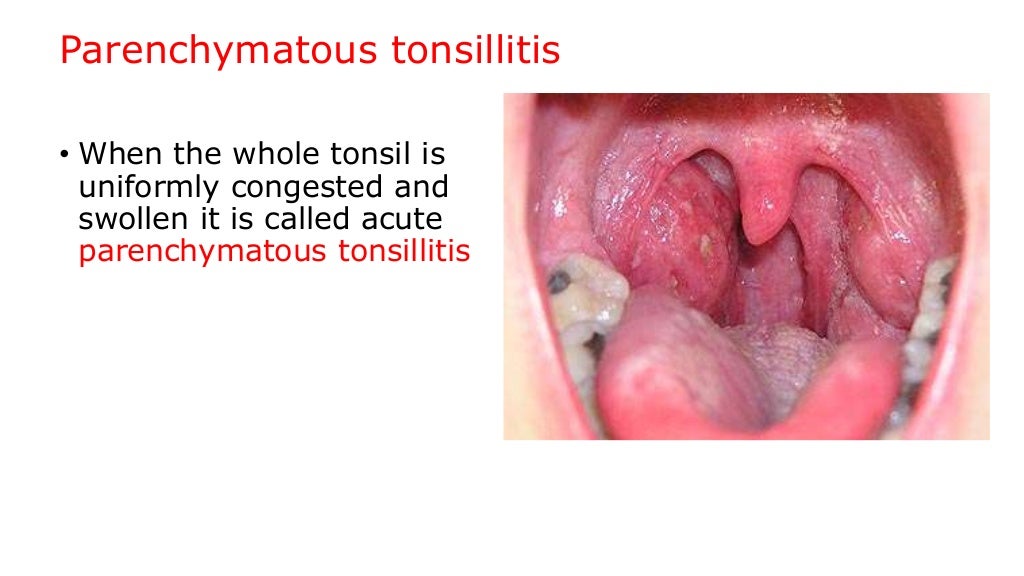 Tonsillitis, quinsy and adenoiditis