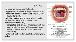 SIGNS
• Dry coated tongue and halitosis
• Hyperemia of pillars, soft palate and uvula
• Yellowish spots at opening of crypts (acute
follicular tonsillitis)
• Whitish membrane present which can be
easily wiped away with a swab (acute
membranous tonsillitis)
• Congested and enlarged tonsils, which may
meet in midline along with edema of uvula
and soft palate (acute parenchymatous
tonsillitis)
• Enlarged and tender jugulodigastric lymph
nodes
 