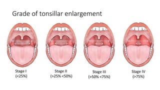 Grade of tonsillar enlargement
 