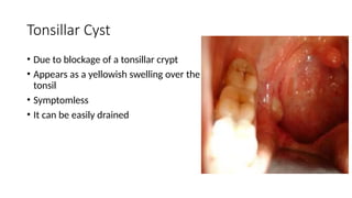 Tonsillar Cyst
• Due to blockage of a tonsillar crypt
• Appears as a yellowish swelling over the
tonsil
• Symptomless
• It can be easily drained
 