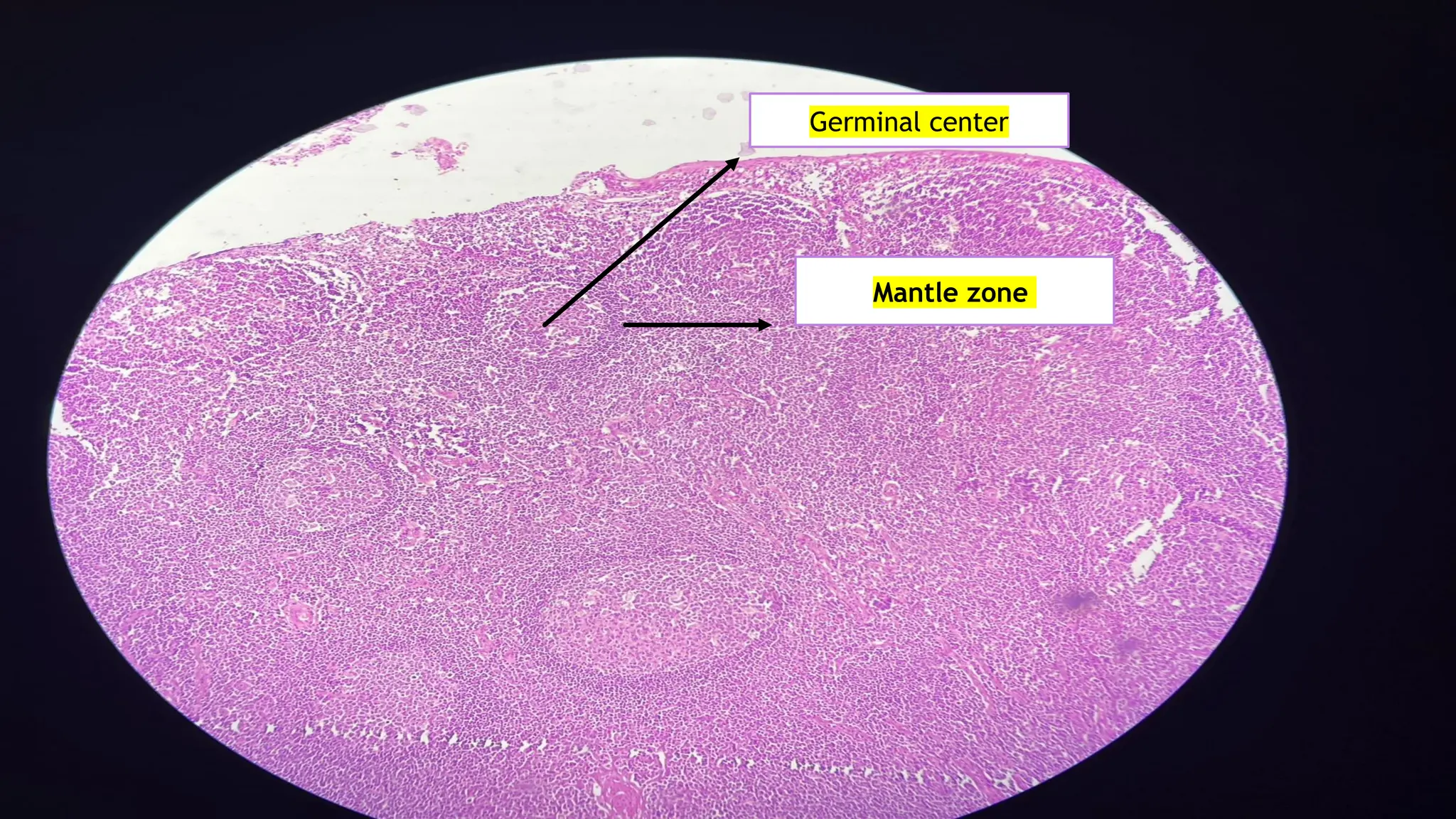 Basel Zone tonsil ppt.pptx important topic on this for ugs | PPTX
