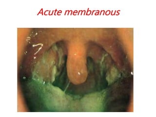 Acute membranous
 