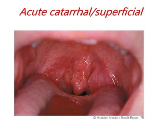 Acute catarrhal/superficial
 