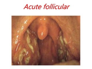 Acute follicular
 