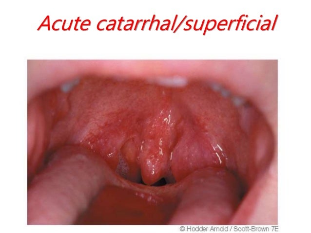 Tonsils and adenoids in children