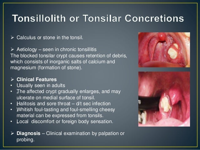 Anatomy Of The Tonsils Anatomical Charts And Posters