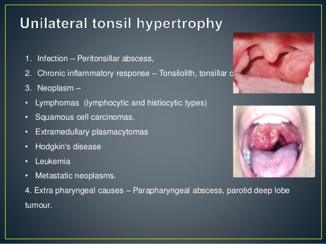 Palatine Tonsil Cyst