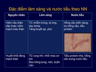 Đặc điểm lâm sàng và nước tiểu theo NN
Nguyên nhân Lâm sàng Nước tiểu
Viêm cầu thận
cấp hoặc viêm
mạch máu thận
TC nhiễm trùng, dị ứng,
đau khớp
Tăng huyết áp, phù
Hồng cầu biến dạng,
trụ hổng cầu, tiểu
protein
Huyết khối động
mạch thận
TC rung nhĩ, nhồi máu cơ
tim
Đau hông lưng, nôn, buồn
nôn
Tiểu protein nhẹ, hồng
cầu trong nước tiểu
 