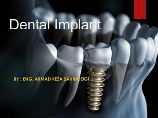Dental Implant
BY : ENG. AHMAD REZA SAHRABEIGI
 