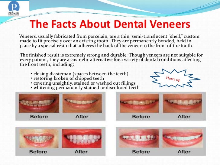 Tooth veneers thailand