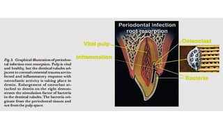 Tooth Avulsion Project tooth avulsion.pdf