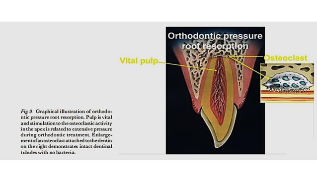 Tooth Avulsion Project tooth avulsion.pdf