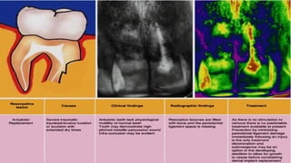 Tooth Avulsion Project tooth avulsion.pdf