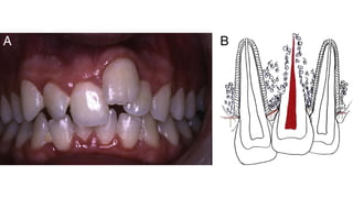 Tooth Avulsion Project tooth avulsion.pdf