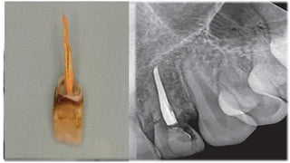 Tooth Avulsion Project tooth avulsion.pdf