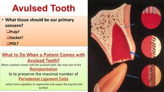 Tooth Avulsion Project tooth avulsion.pdf