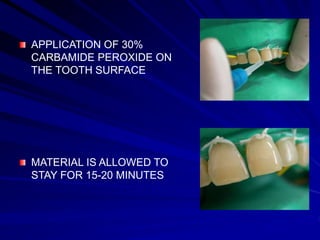 APPLICATION OF 30%
CARBAMIDE PEROXIDE ON
THE TOOTH SURFACE
MATERIAL IS ALLOWED TO
STAY FOR 15-20 MINUTES
 