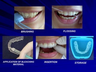 BRUSHING FLOSSING
APPLICATION OF BLEACHING
MATERIAL
INSERTION STORAGE
 