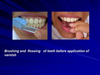 Brushing and flossing of teeth before application of
varnish
 