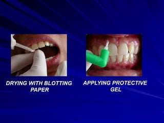 DRYING WITH BLOTTING
PAPER
APPLYING PROTECTIVE
GEL
 