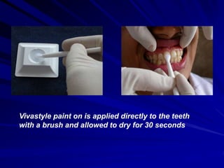 Vivastyle paint on is applied directly to the teeth
with a brush and allowed to dry for 30 seconds
 