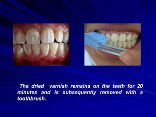 The dried varnish remains on the teeth for 20
minutes and is subsequently removed with a
toothbrush.
 