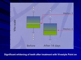 Significant whitening of teeth after treatment with Vivastyle Paint on
 
