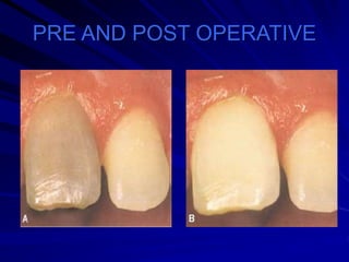 PRE AND POST OPERATIVE
 