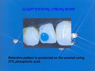 SLIGHT ETCHING; STRONG BOND
Retentive pattern is produced on the enamel using
37% phosphoric acid.
 
