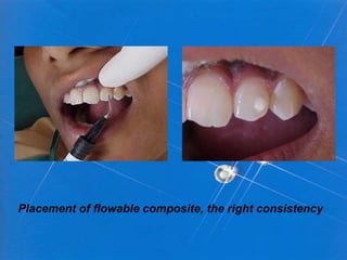 Placement of flowable composite, the right consistency
 