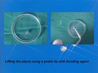 Lifting the skyce using a probe tip with bonding agent
 