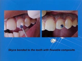 Skyce bonded to the tooth with flowable composite
 