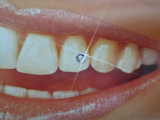 TOOTH BLEACHING - 58 slides.ppt