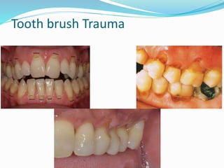 Tooth brush Trauma
 