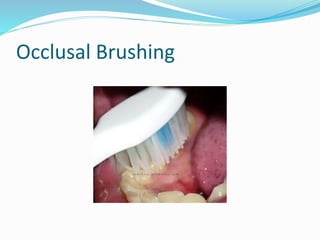 Occlusal Brushing
 