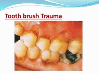 Tooth brush Trauma
 