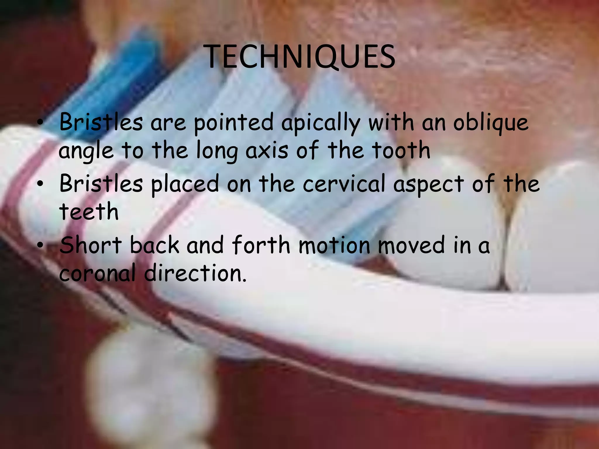 TECHNIQUES
• Bristles are pointed apically with an oblique
angle to the long axis of the tooth
• Bristles placed on the cervical aspect of the
teeth
• Short back and forth motion moved in a
coronal direction.

 