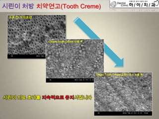 시린이 처방 치약연고(Tooth Creme)
Clinpro Tooth Crème 사용 후
Clinpro Tooth Crème(오렌지 주스 노출 후)
사용 전 치아표면
시린이 치료 효과를 지속적으로 유지시킵니다
 