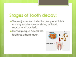 Stages of Tooth decay:
 The major reason is dental plaque which is
a sticky substance consisting of food,
mucus and bacteria.
 Dental plaque covers the
teeth as a hard layer.
 