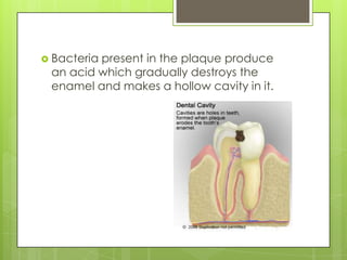  Bacteria present in the plaque produce
an acid which gradually destroys the
enamel and makes a hollow cavity in it.
 