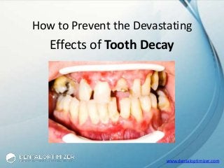www.dentaloptimizer.com
How to Prevent the Devastating
Effects of Tooth Decay
 