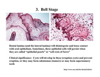 3. Bell Stage




Dental lamina (and the lateral lamina) will disintegrate and loose contact
with oral epithelium. Sometimes, these epithelial cells will persist when
they are called “epithelial pearls” or “cell rests of Serre”

Clinical significance: Cysts will develop in these (eruption cysts) and prevent
eruption, or they may form odontomas (tumors) or may form supernumery
teeth

                                                   http://www.usc.edu/hsc/dental/ohisto/
 