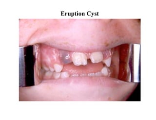 Eruption Cyst
 